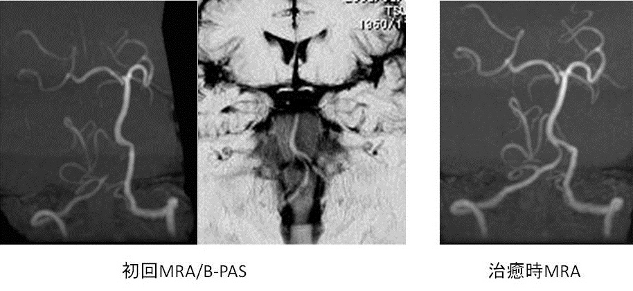 Bpas 2 椎骨動脈解離のmri 画像上の分類と経過について Mrifan Net