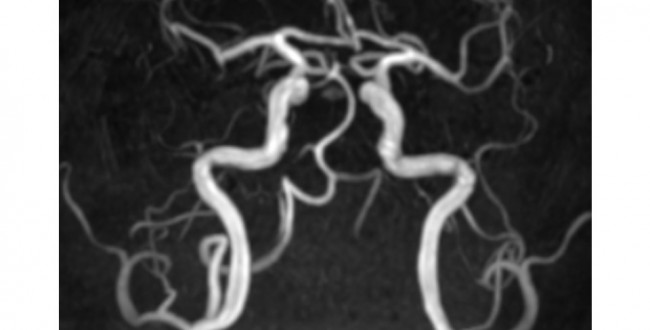 MRIクイズ (1) ーTOF-MRAの特性から疾病を推定する | MRIfan.net