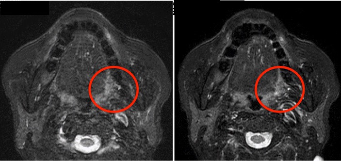 舌 mri – 舌の付け根から喉が痛い – PUAAOM