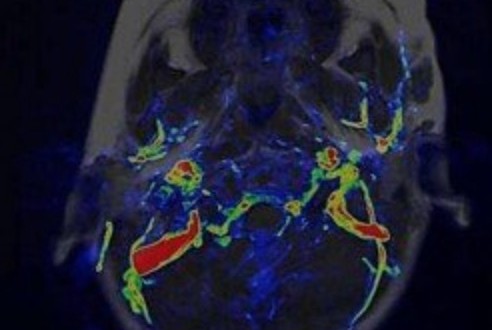 顔面血管腫～周囲血管を非造影にて簡便に描出する！～（The best