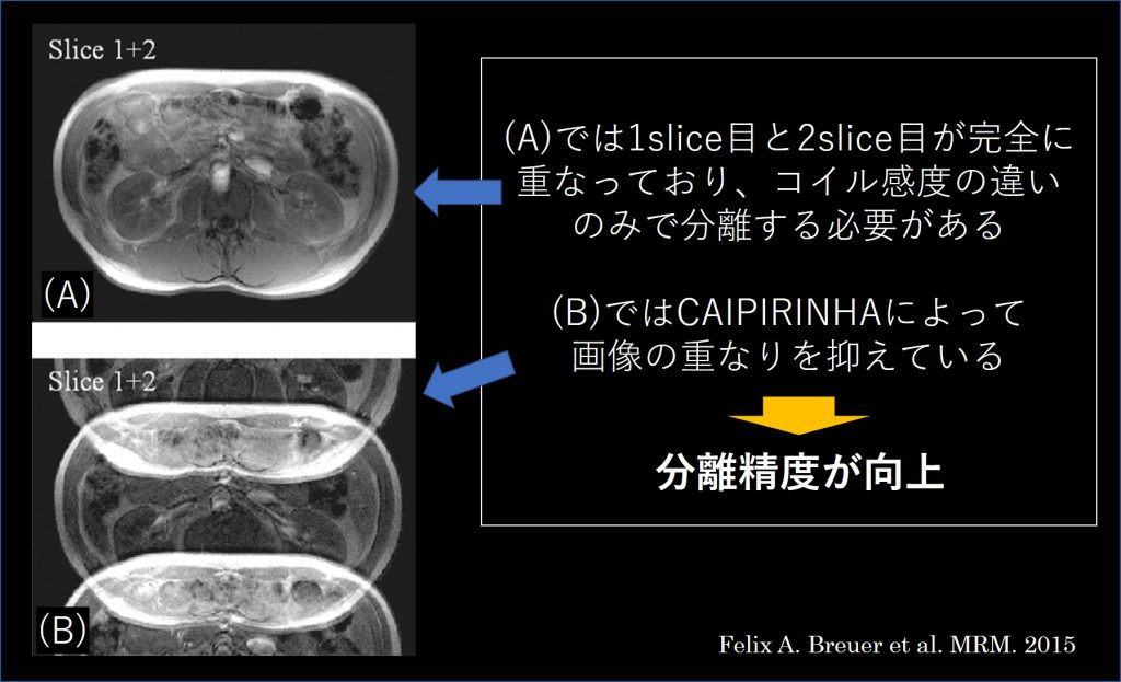 Multiband / Simultaneous Multi-Slice | MRIfan.net