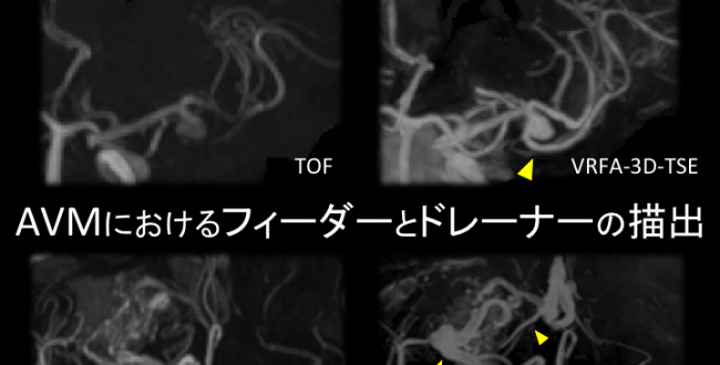知っておきたい頸部~頭部動脈破格 MRAとCTAの読影が楽しくなる