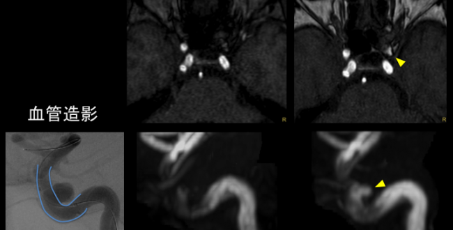 頭部MRAのちょっとした工夫（2） | MRIfan.net