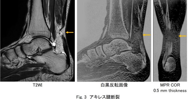 シングルエコーによるアキレス腱描出シーケンス | MRIfan.net