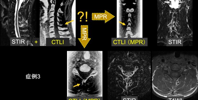 誰でも撮れる？『頚椎CTLI』 | MRIfan.net