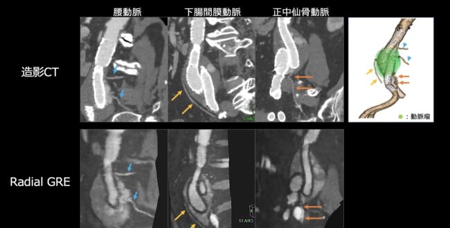 専用出品！mri〜様 自由呼吸・非同期・非造影MRA『Radial GRE』 | MRIfan.net