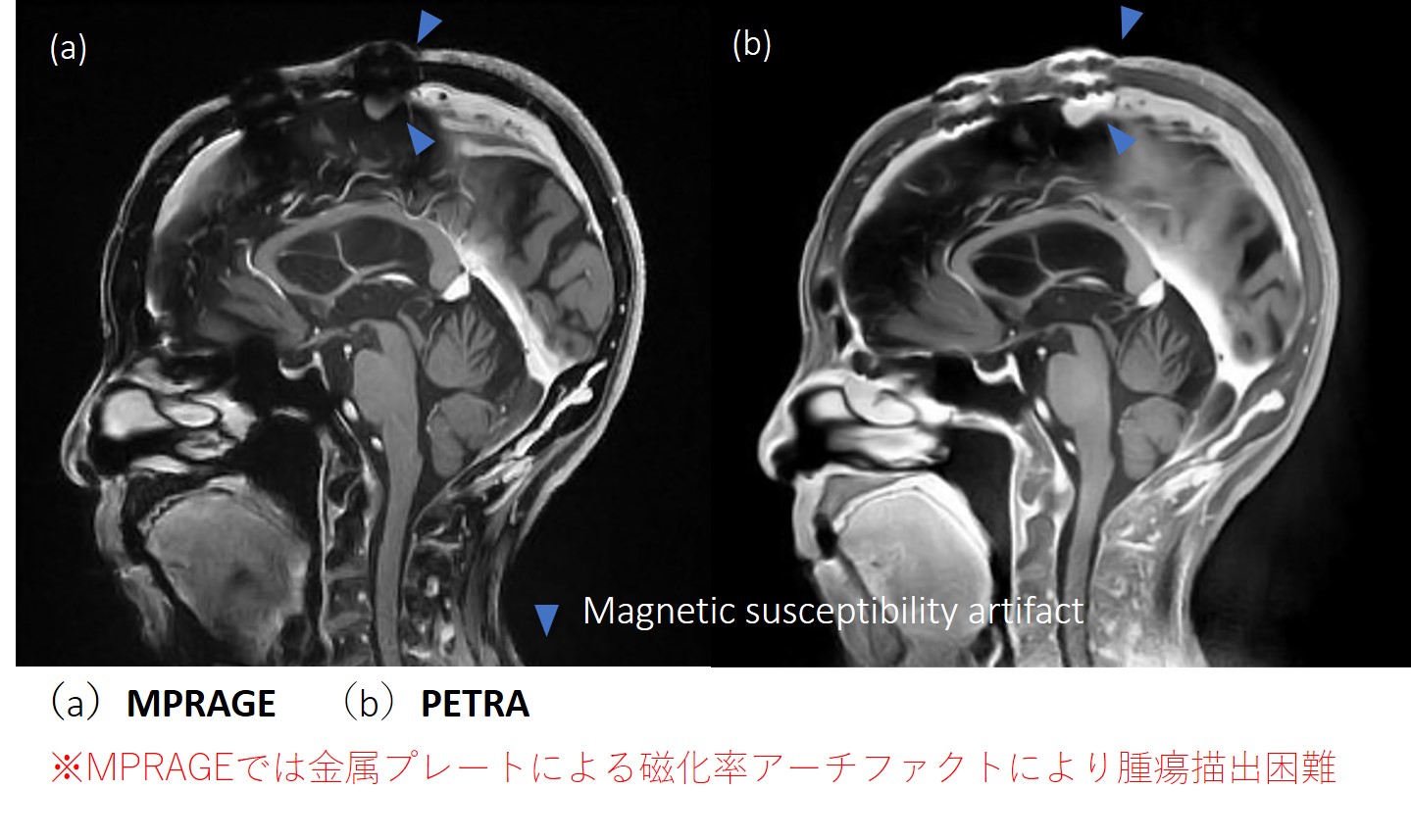 petra b 脳腫瘍術前検査はultra-short TEシーケンス（PETRA）におまかせ | MRIfan.net