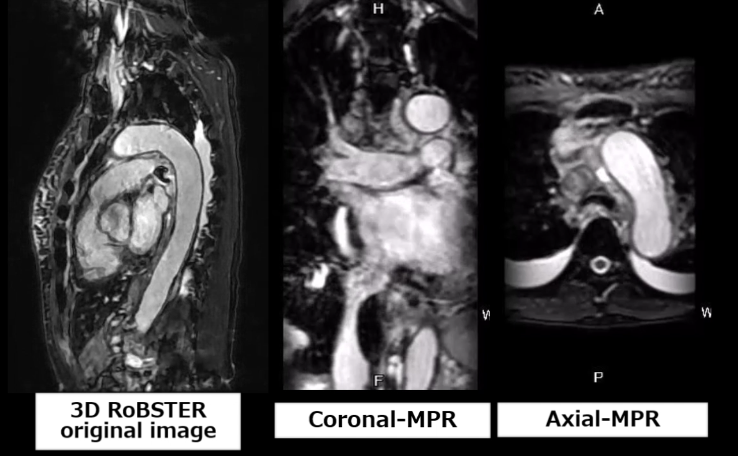 非造影 大血管イメージング 3D Fiesta with RoBSTER | MRIfan.net