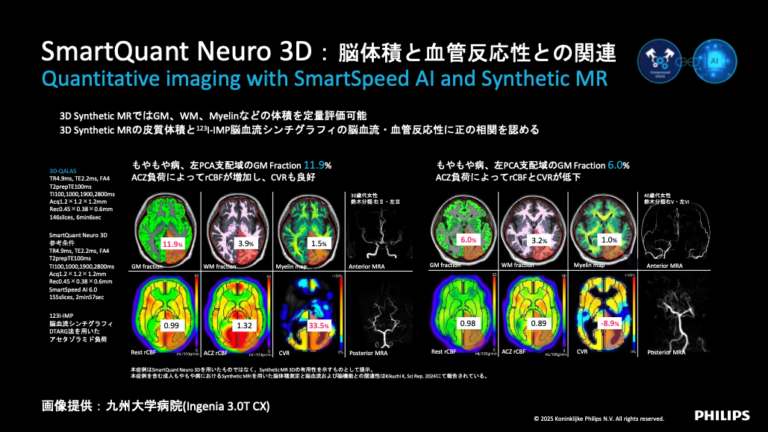ITEM2025レポート〜Philips編〜 | MRIfan.net