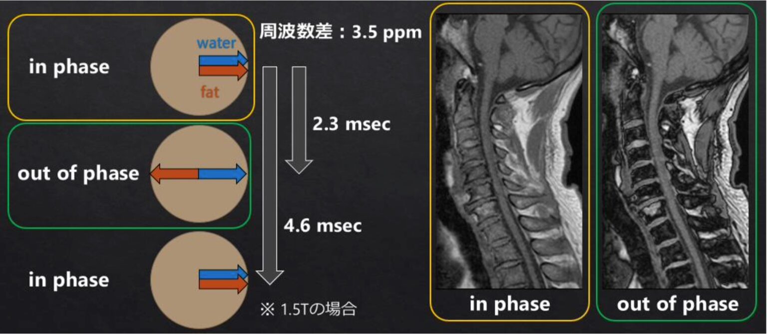 GRE と各種Dixon によるin phase、out of phase での信号変化について | MRIfan.net