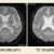磁化率強調画像と無症候性微小脳出血